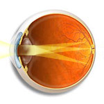 Astigmatism