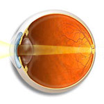 Hyperopia