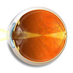 Myopia