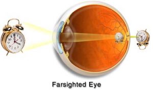Cross-Section of a Farsighted Eye