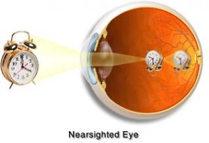 Cross-Section of a Nearsighted Eye